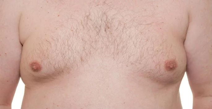 Gynecomastia