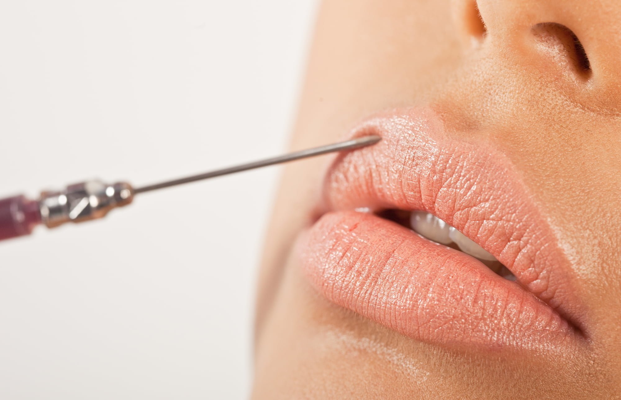 Lip Enhancement Treatment. Closeup of a hypodermic needle being using to inject the upper lip in an enhancement treatment.