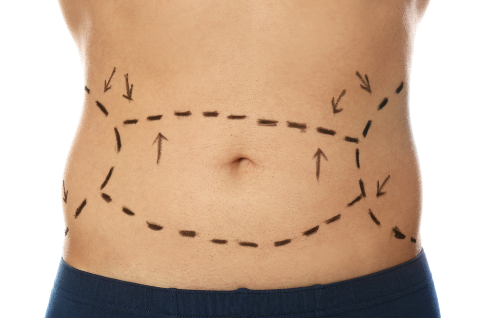 questions tummy tuck preparation recovery